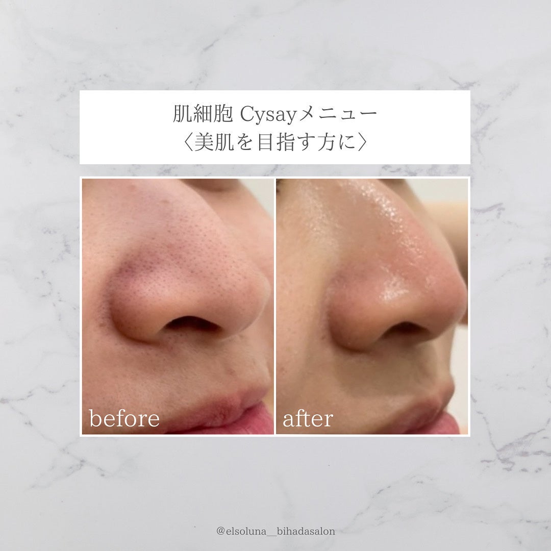 今、美容業界で話題の次世代ハーブピーリング！植物幹細胞の力で肌細胞を活性化させ、陶器のような美しい肌に！多くの著名人もお忍びで通う、話題のエステティックサロン『美肌サロンElsoluna南青山』のサブ画像6