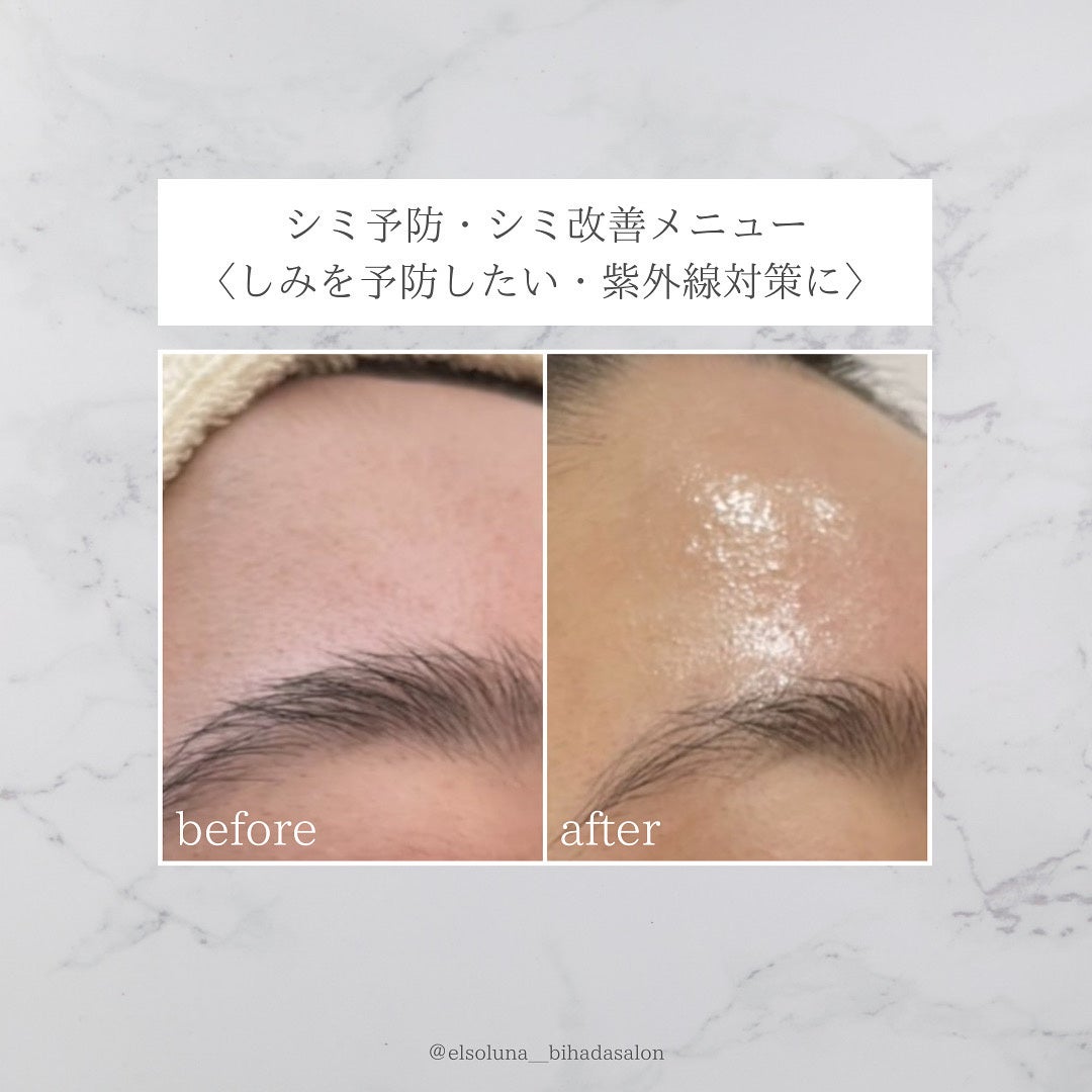 今、美容業界で話題の次世代ハーブピーリング！植物幹細胞の力で肌細胞を活性化させ、陶器のような美しい肌に！多くの著名人もお忍びで通う、話題のエステティックサロン『美肌サロンElsoluna南青山』のサブ画像8