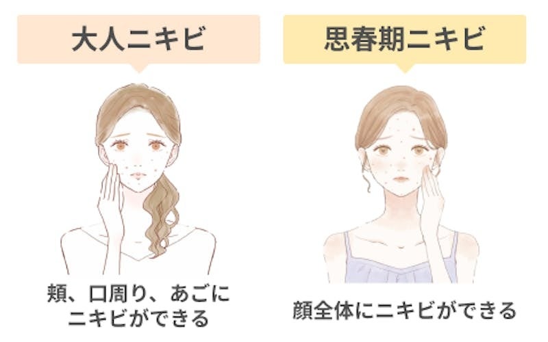 ニキビケア商品は価格・口コミよりも肌質・成分を重視、敏感肌向け商品購入者の約半数は乾燥肌・混合肌のサブ画像6